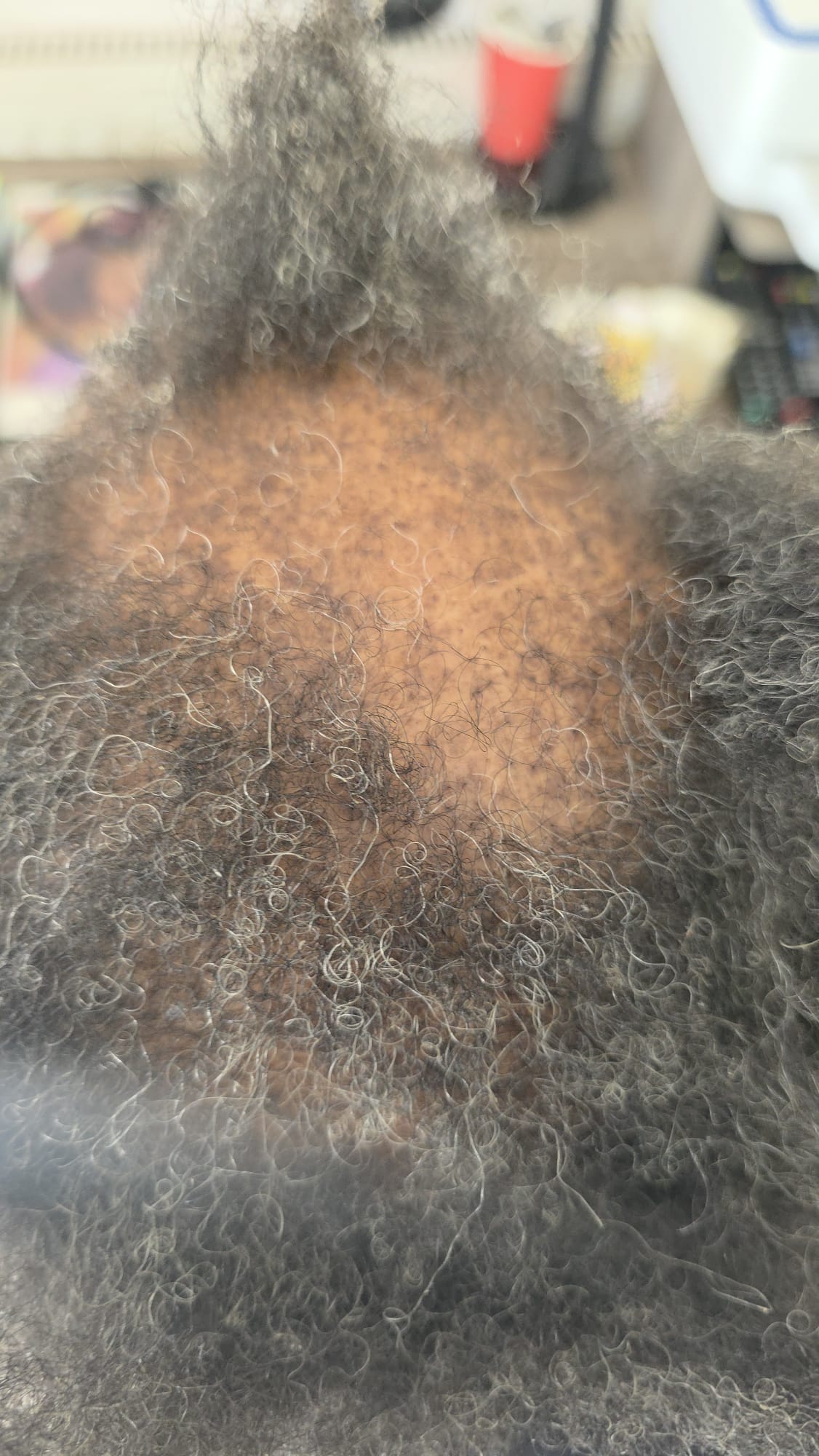Scalp Examination
