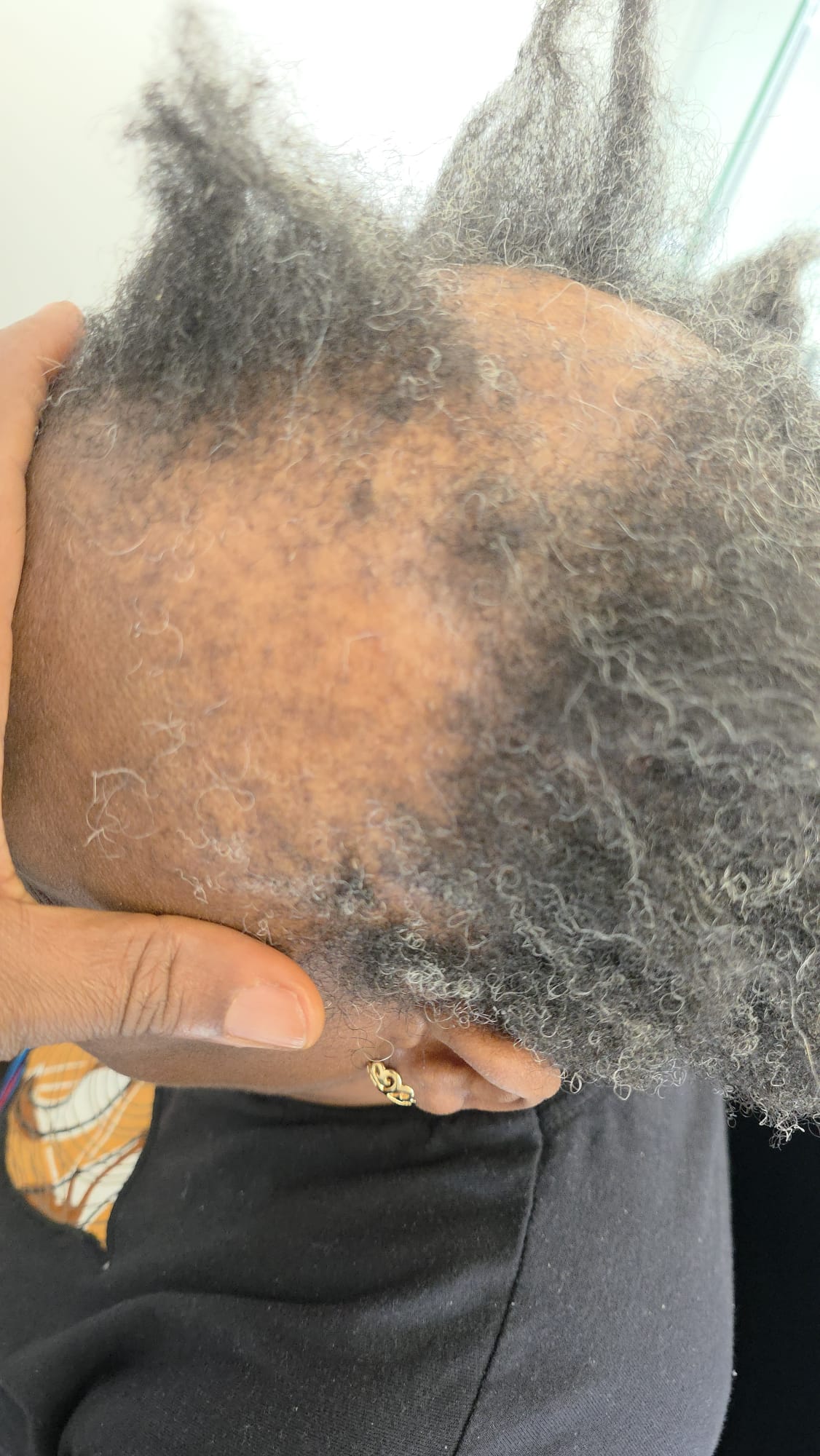 Scalp Examination