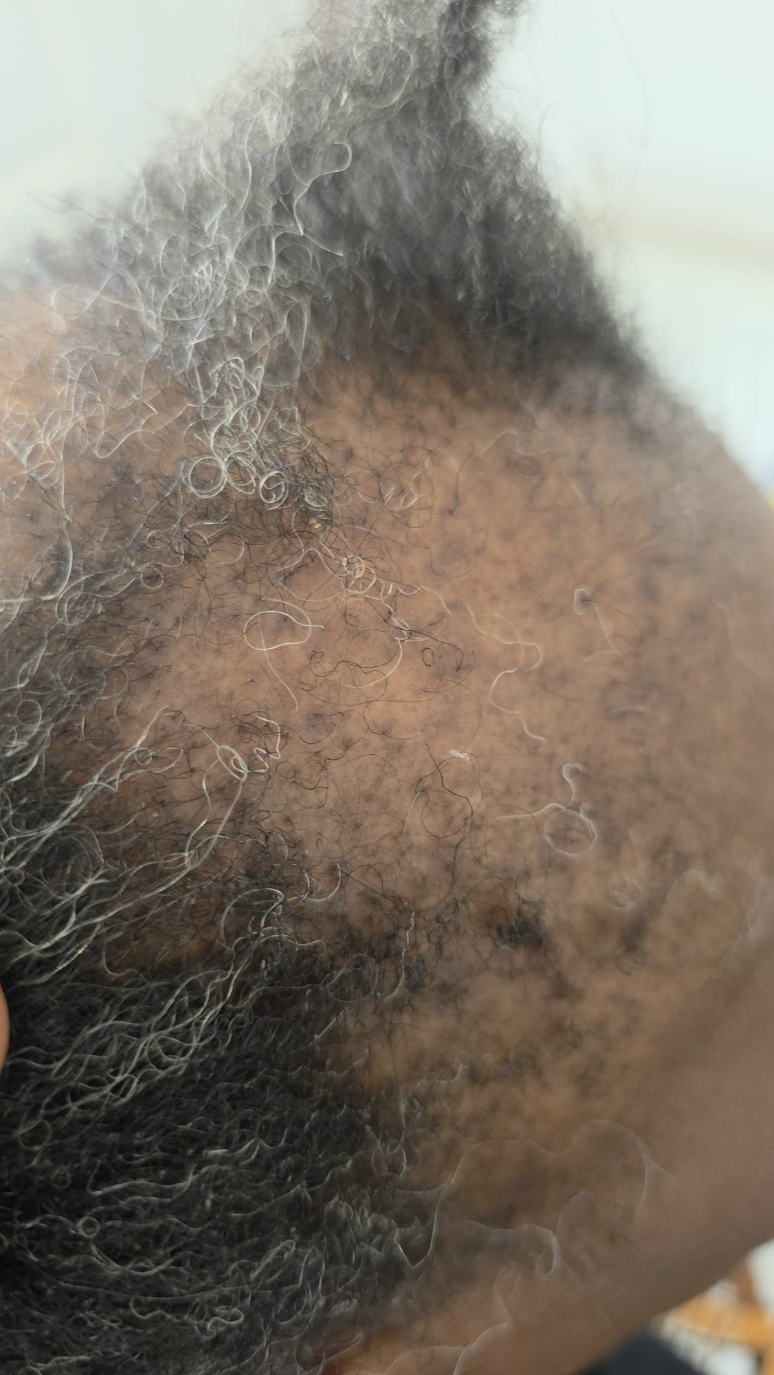 Scalp Examination