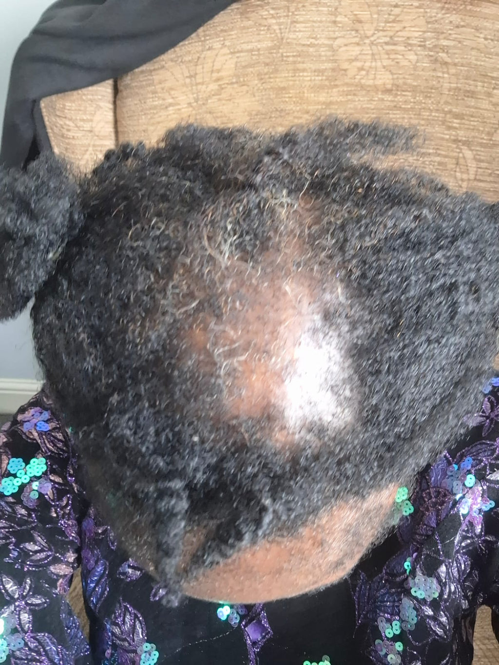 Consultation & follow-Up for Inflamed Scalp, FFA & CCCA (5 in 1)