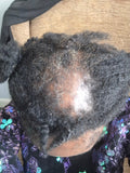 Consultation & follow-Up for Inflamed Scalp, FFA & CCCA (5 in 1)
