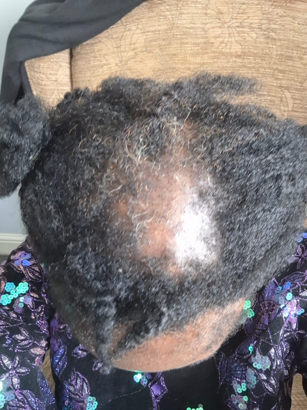 Consultation & follow-Up for Inflamed Scalp, FFA & CCCA (5 in 1)