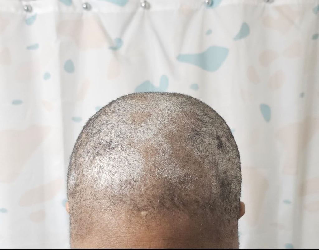 6-in-1 Detox Treatement for Dandruff, Itchy Scalp & Rash