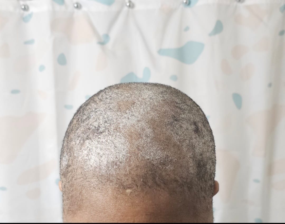6-in-1 Detox Treatement for Dandruff, Itchy Scalp & Rash