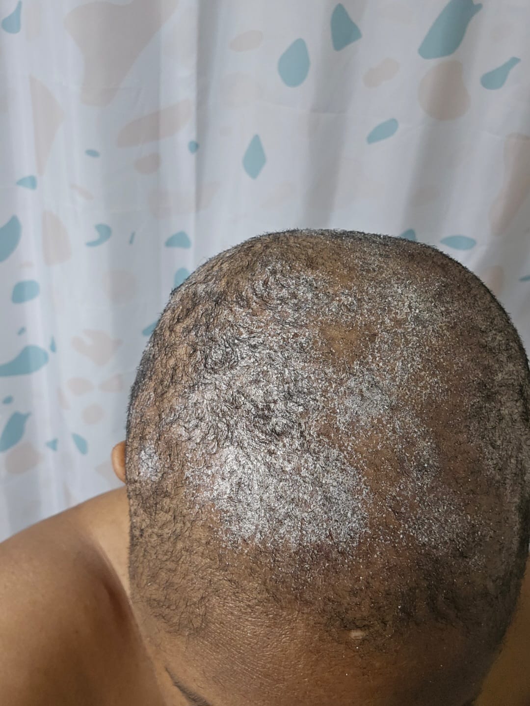6-in-1 Detox Treatement for Dandruff, Itchy Scalp & Rash