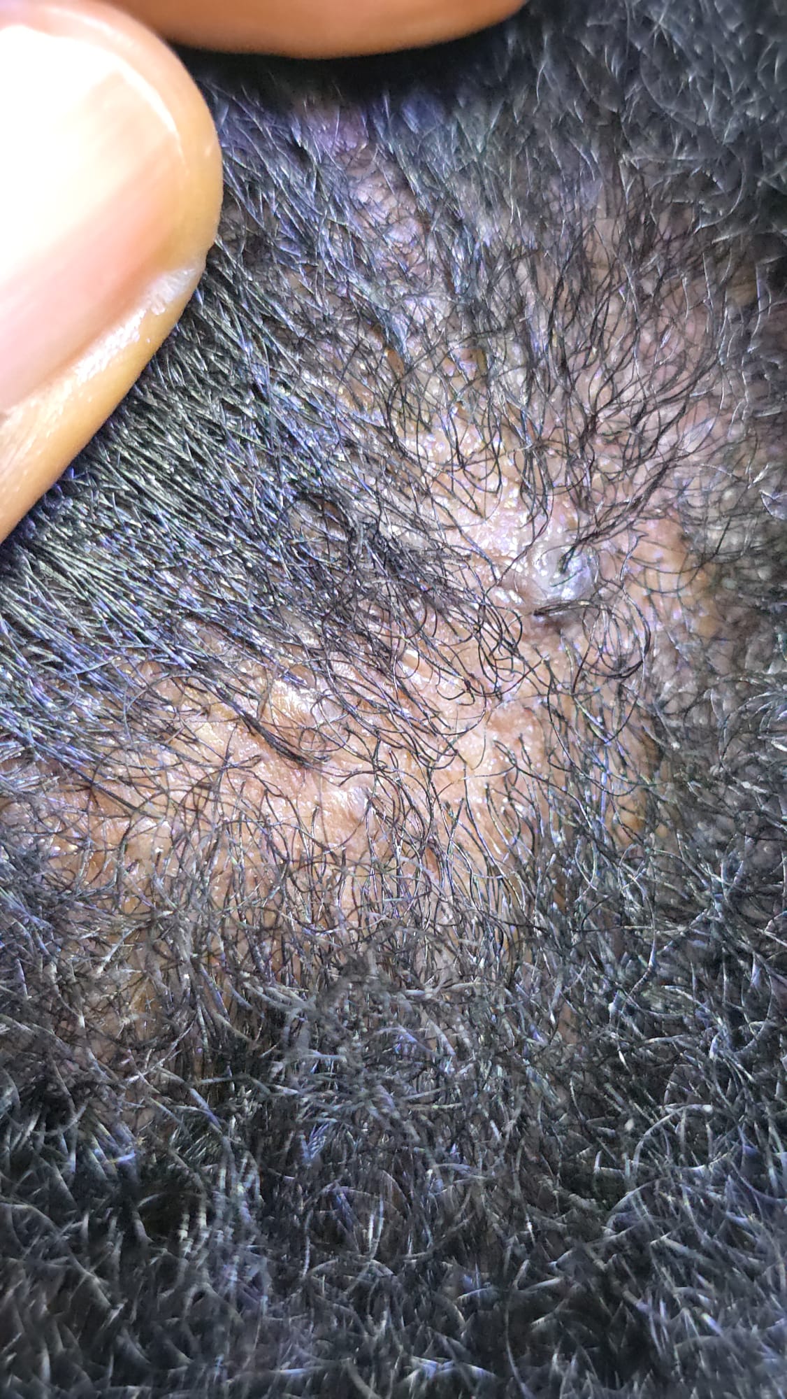 6-in-1 Detox Treatement for Dandruff, Itchy Scalp & Rash