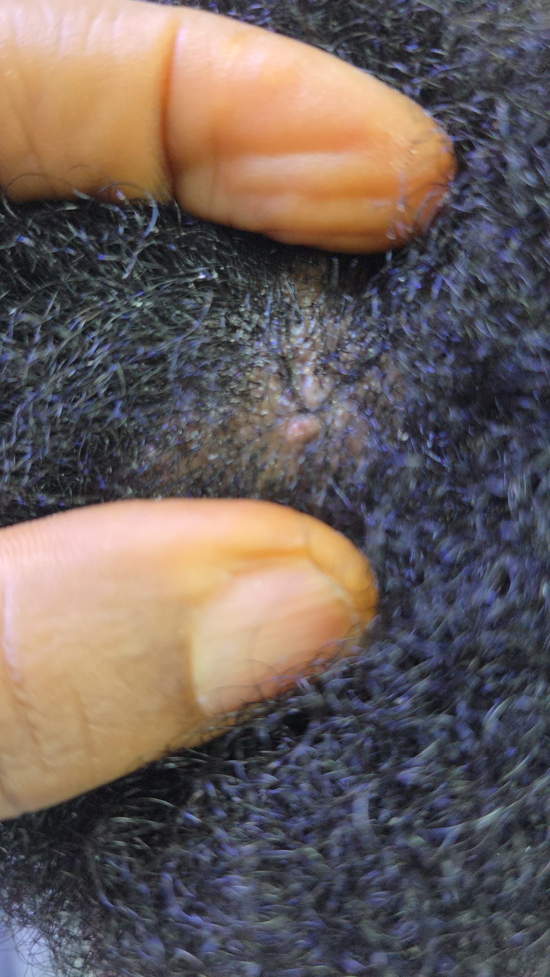 Scalp Examination