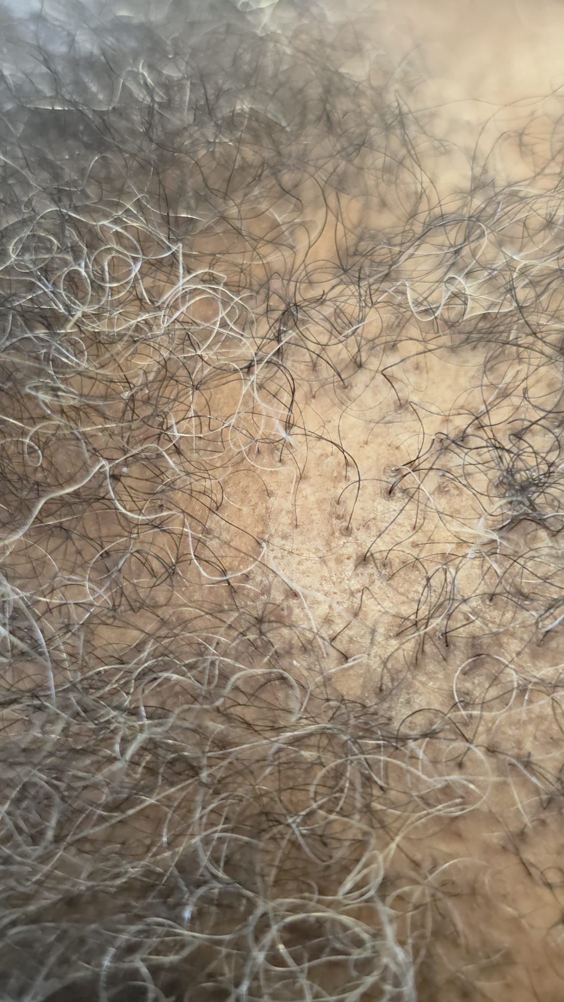 Scalp Examination