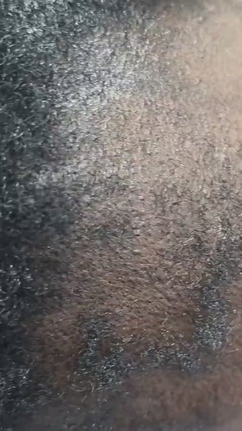 Chemical Burn Dyeing and Colouring Hair
