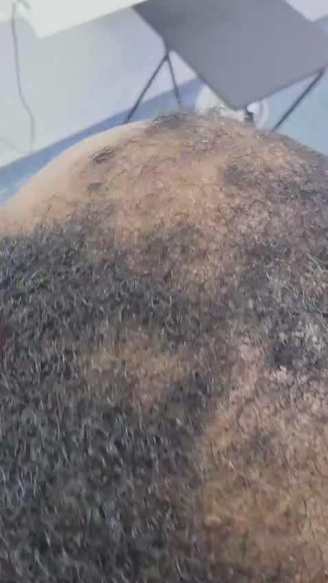 Men Combo Treatment (Inflammation scalp crown bald patches and temple corner)