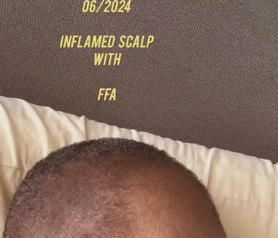 Inflammed Scalp Combo