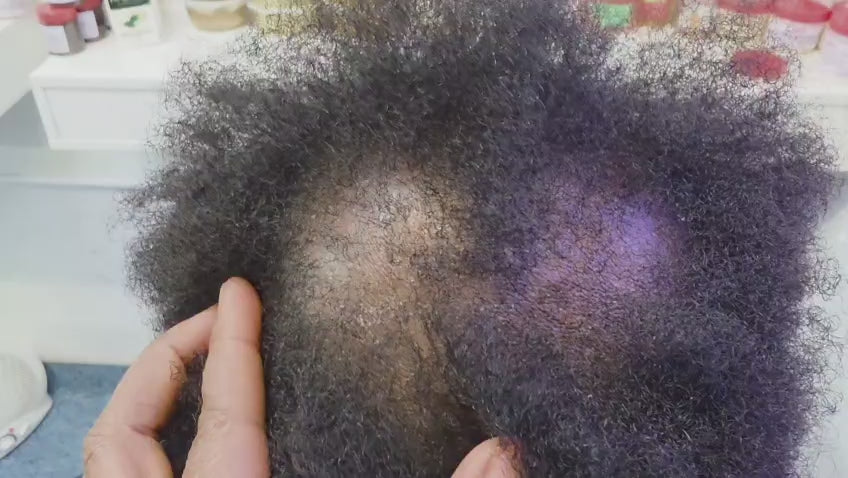 Consultation & follow-Up for Inflamed Scalp, FFA & CCCA (5 in 1)