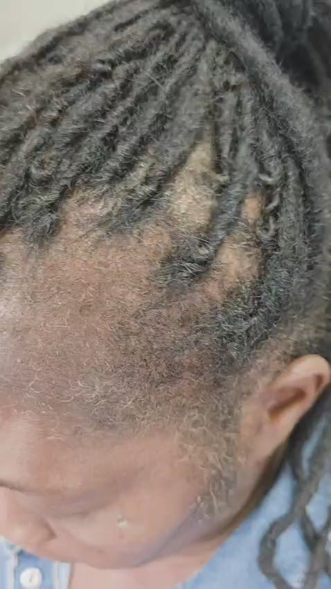 Inflamed  scalp Edges Patches Combo and itchy scalp