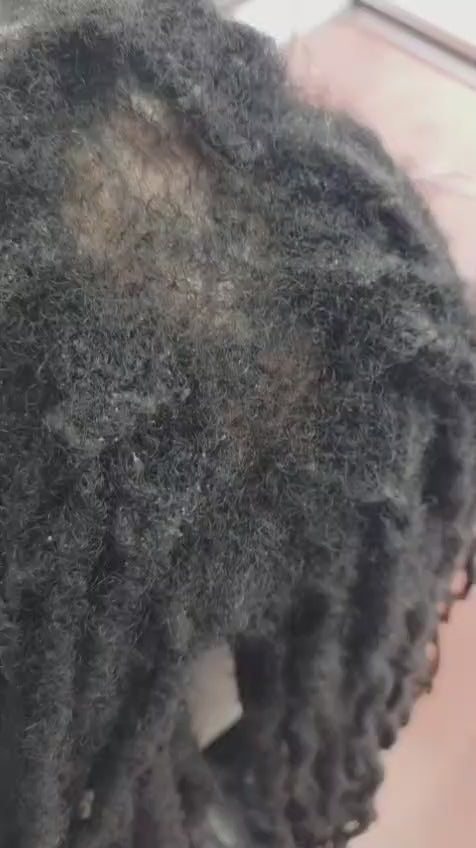 Dry Scalp and Itchy Locs