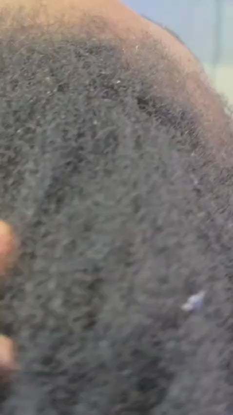 Excessive Shedding